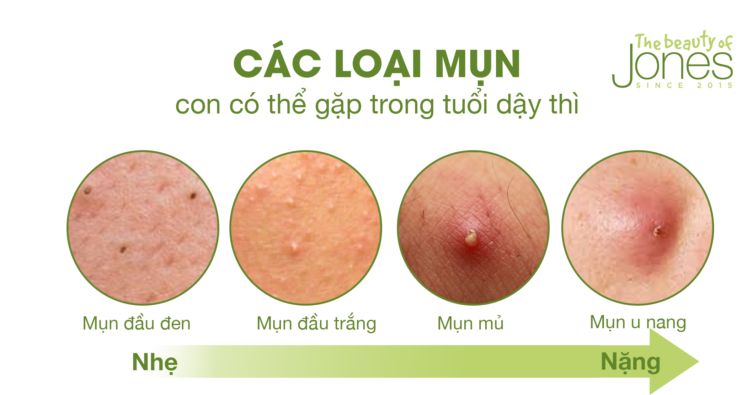 Các loại mụn thường gặp ở tuổi dậy thì: Nguyên nhân và cách điều trị hiệu quả